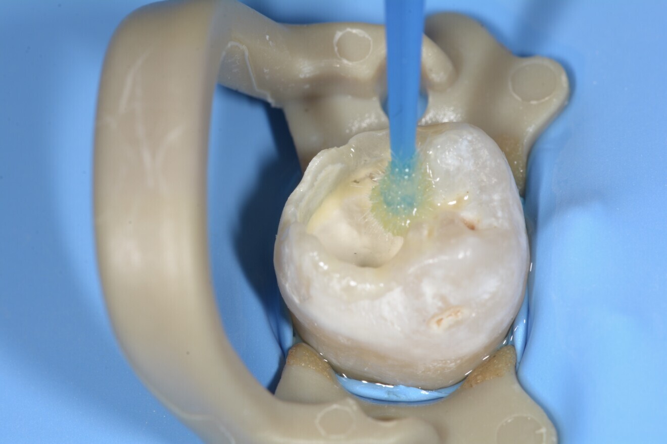 Fig. 14 : Mise en place de l’adhésif.