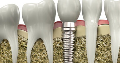 Implantate: Strom tötet Bakterien ab