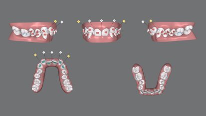 Invisalign Personalized Plan: una nuova funzionalità time-saver per medico e paziente