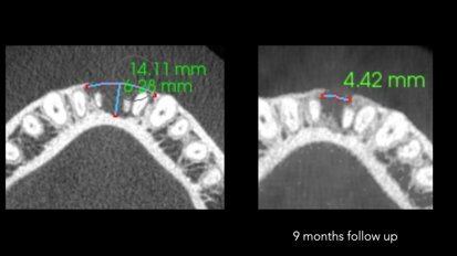 Promovisanje prirodnog vertikalnog rasta kosti - nije mit već stvarnost
