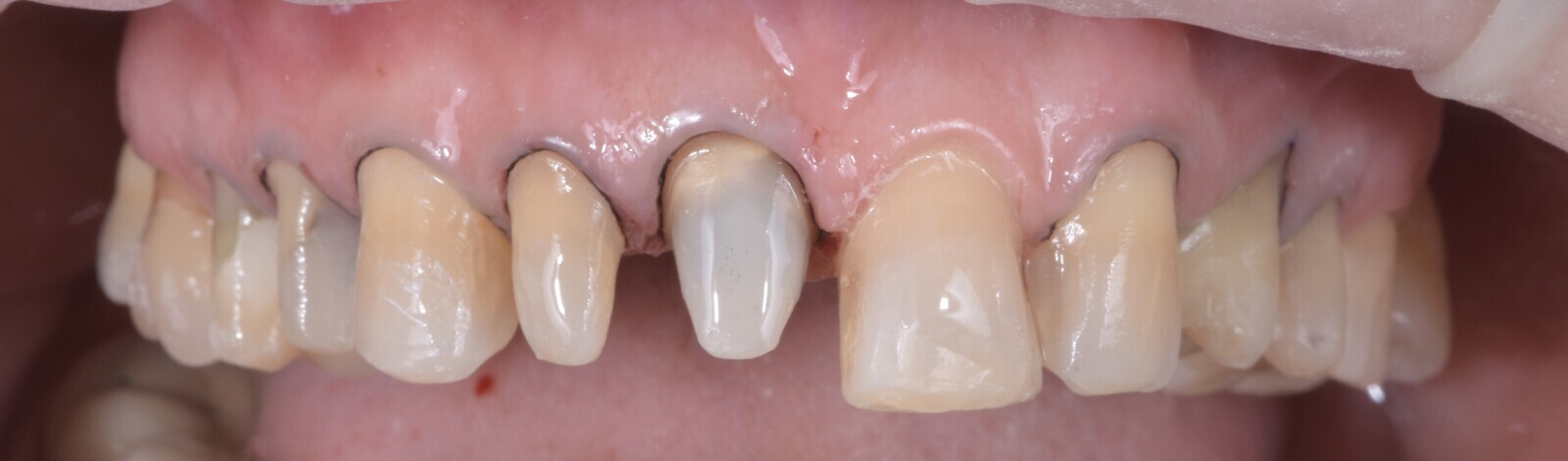 Fig. 17: Prepared teeth after placement of gingival retraction cord.
