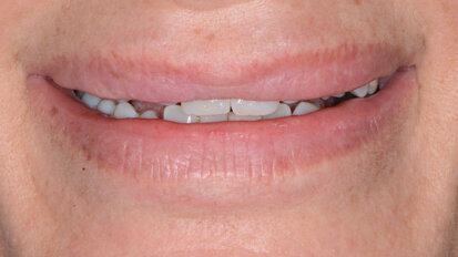 Esigenza di approccio interdisciplinare per l’armonia estetica del sorriso: case report