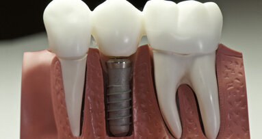Bessere Osseointegration durch Speichelpeptide