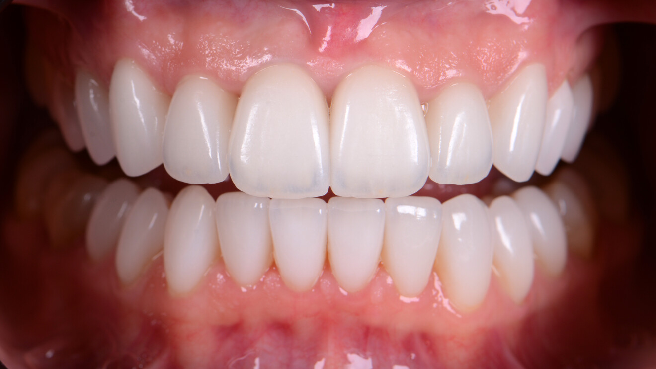 Fig. 30: Pink and white aesthetics achieved with the ceramic restorations.