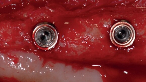 Histomorphometric analysis of bone healing at implants with turned or rough surfaces: An experimental study in the dog
