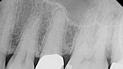 Troubleshooting calcified canals: clinical case review Troubleshooting calcified canals: clinical case review