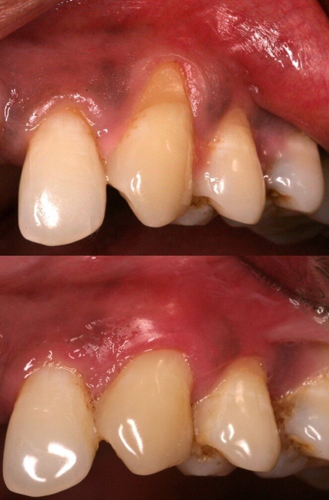 Figure 2: Baseline and 5 yr post op photos after root coverage using a CT graft. Stable long term soft tissue attachment is predictable. 

