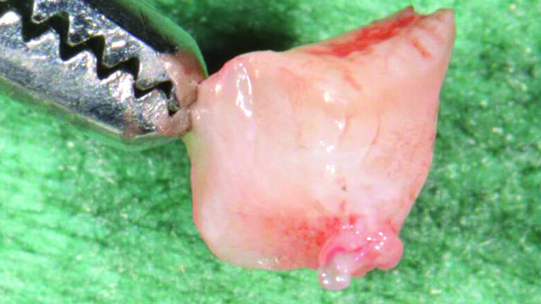 Impianti post-estrattivi precoci abbinati a CTG in sella edentula intercalata