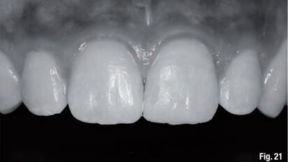 Anatomic stratification technique for lifelike anterior composites