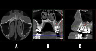 Resolución de sinusitis maxilar odontogénica mediante cirugía periapical