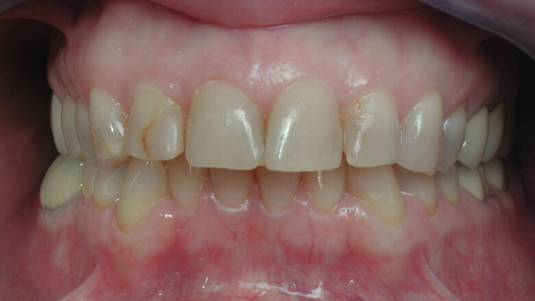 Sobre las carillas cerámicas