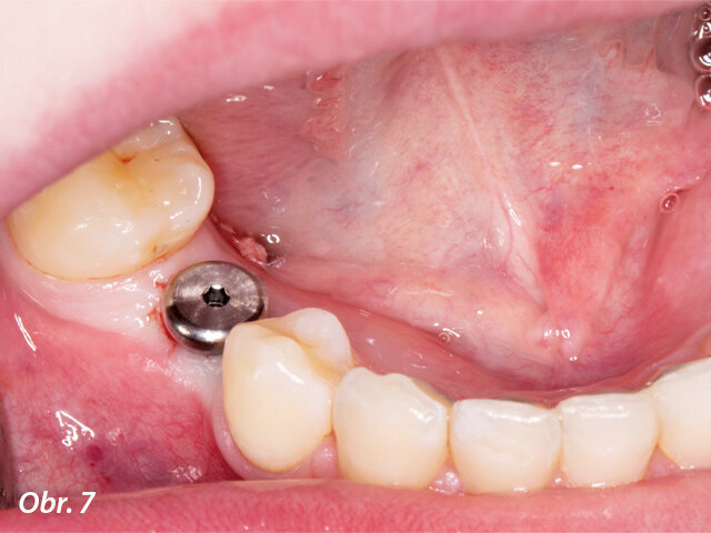 Na implantát byl po chirurgickém zákroku umístěn vhojovací abutment.