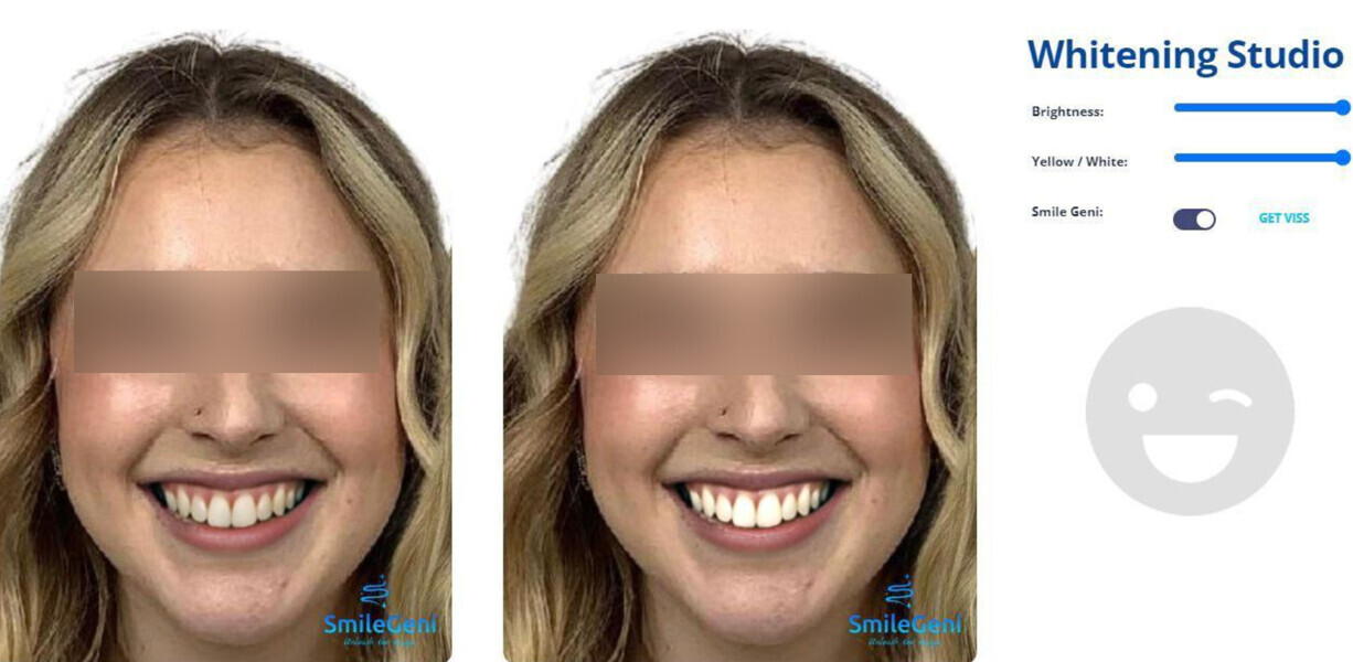 Fig. 4: Whitening tool.