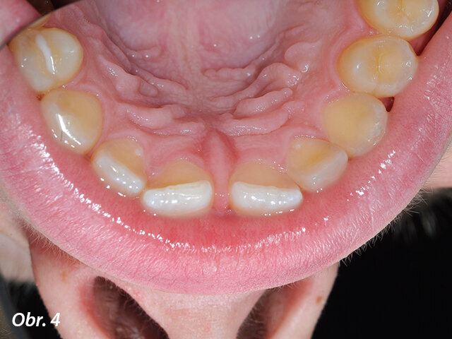 Iniciální situace ukazující diastema.