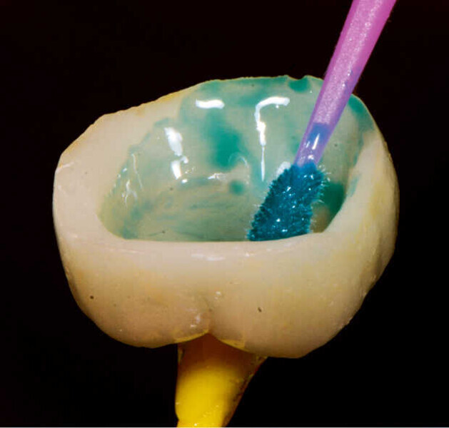 Fig. 5. Grabado y silanizado con Monobond Etch & Prime.