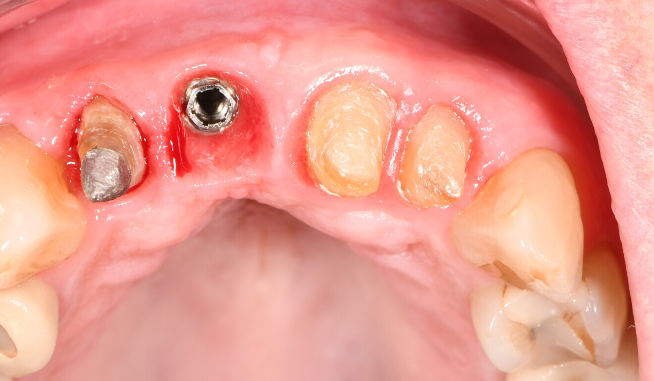 Fig. 12: Intra-oral situation prior to restoration placement.