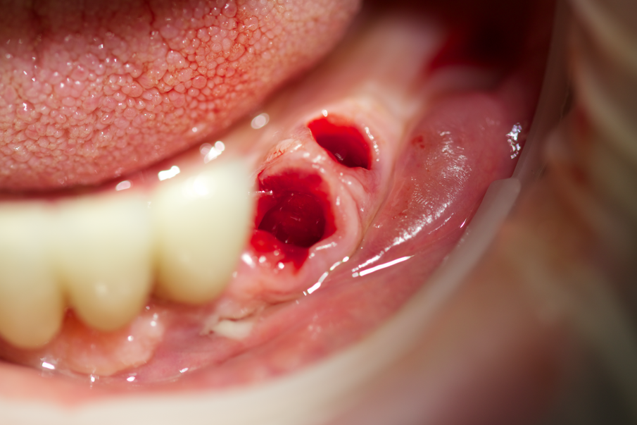 Fig. 13 - Avulsione di 3.3 e 3.4.