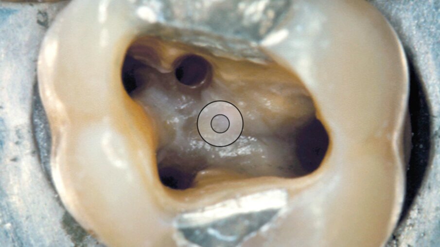 Fig. 8 - I quattro canali di questo primo molare superiore sono stati detersi e sagomati.