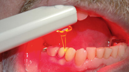 LED als alternative Behandlungsmethode zum Laser?