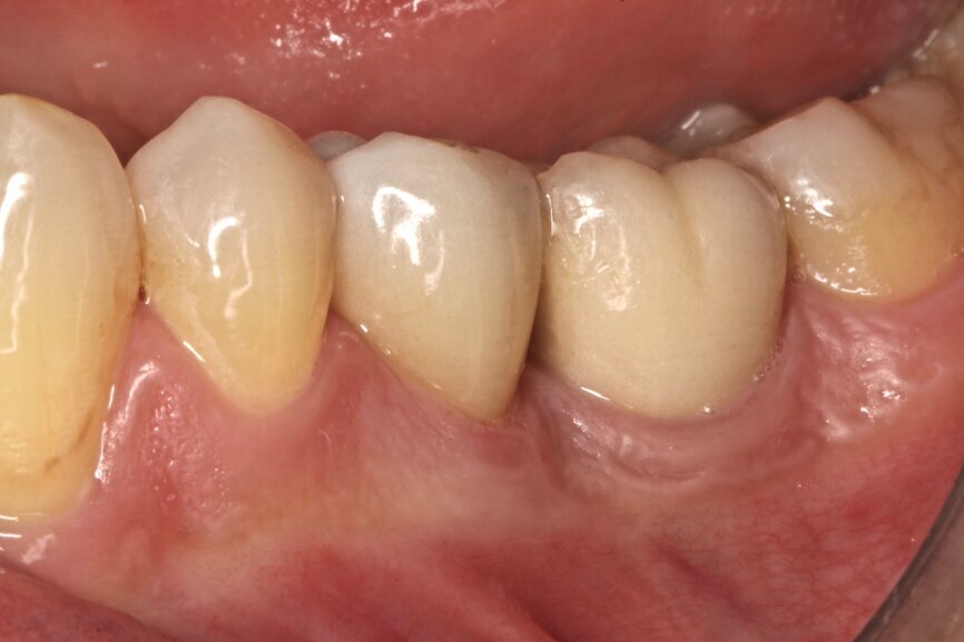Fig. 10: Clinical situation one year after treatment.