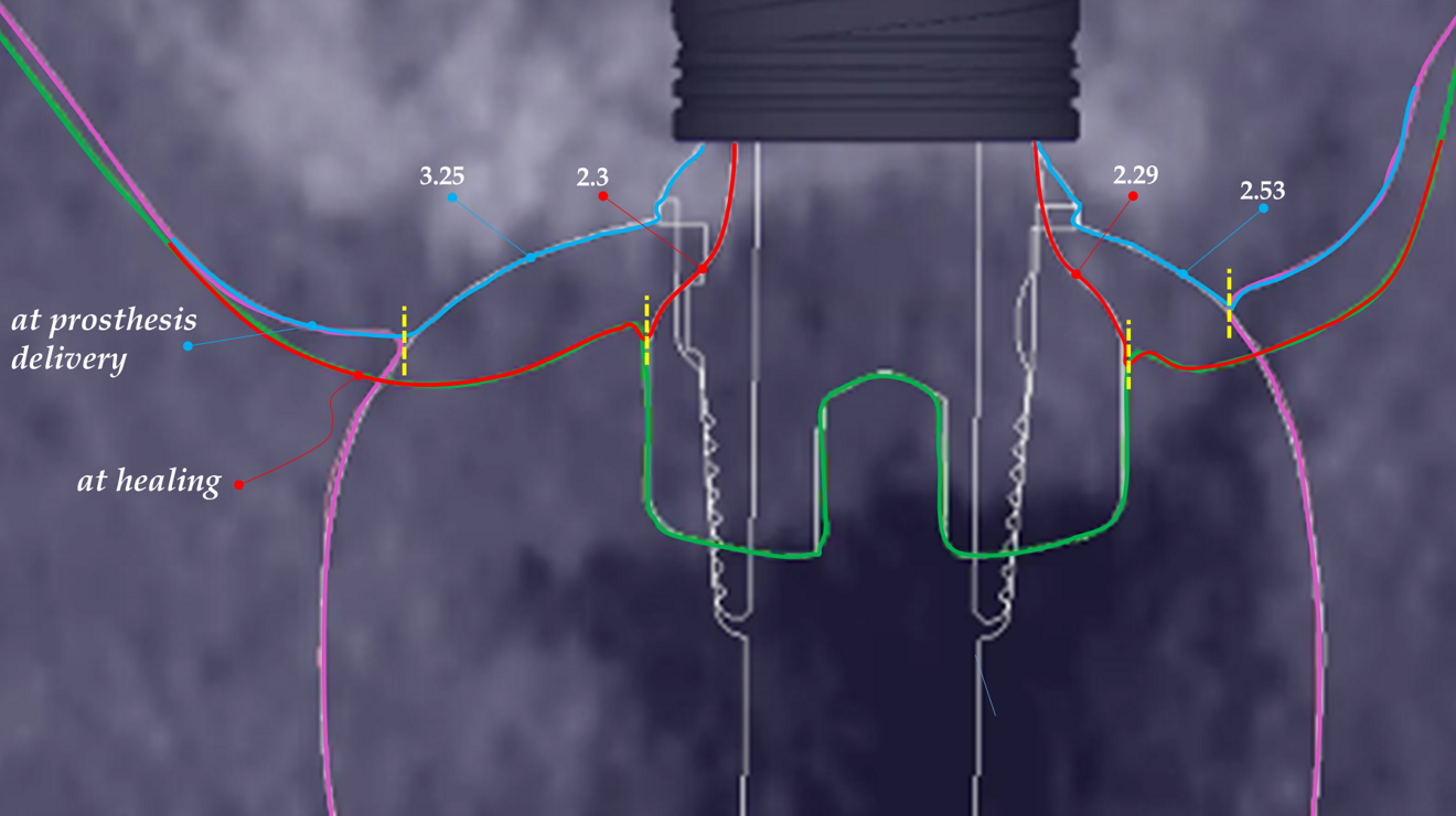 Fig. 7c: Comparison of the shape and estimated length of the gingival seal at the end of healing (red line) and at prosthesis delivery (blue line). On the palatal side (left side of the image), the gingival seal at prosthesis delivery under the crown is larger by 0.95 mm than the one obtained at the end of the healing. Yellow dotted lines = top of the gingival margin and beginning of the sulcus.