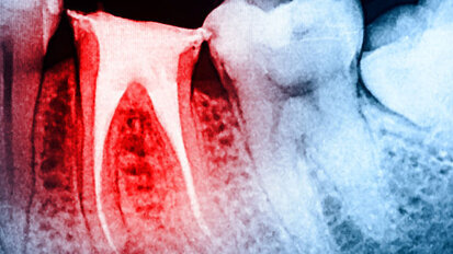 Los beneficios de los instrumentos rotatorios NiTi con movimiénto recíproco Los beneficios de los instrumentos rotatorios NiTi con movimiénto recíproco