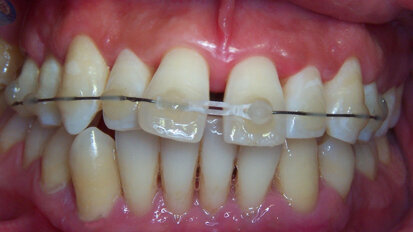 L'orthodontie sans attaches fixes