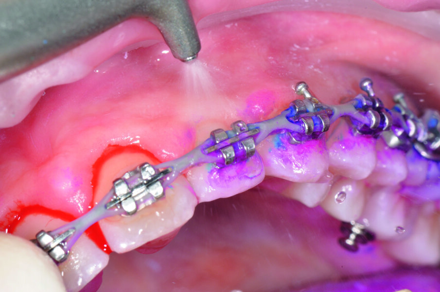 Fig. 4 - Rimozione di biofilm e tartaro, utilizzando il manipolo AIRFLOW e la polvere PLUS.