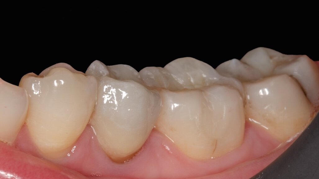 El espectrofotómetro en la estética dental