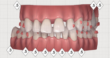 Multidisciplinární léčba u pacienta se závažnou parodontitidou