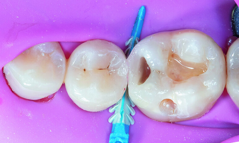 Fig. 7. Converting Class II to Class I with Beautifil II LS shade A2.