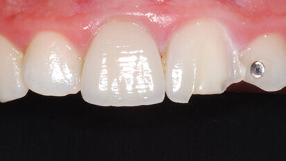 Ripristino estetico con tecnica press on paint nella pratica quotidiana