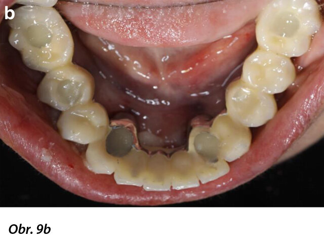 Okluzální pohledy na abutmenty (a) a okamžitě umístěnou provizorní náhradu, která byla připevněna in situ pasivně (b).