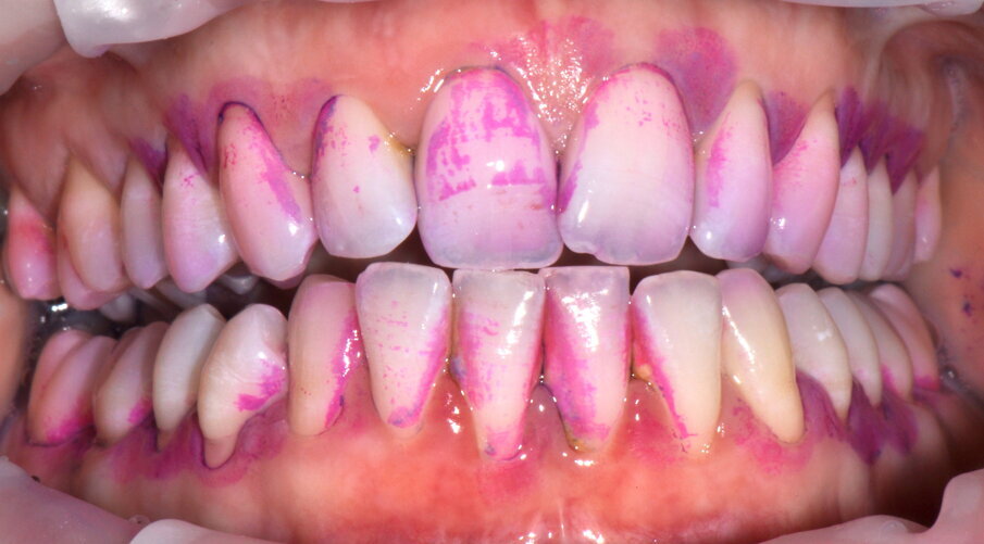 Figg. 6a-6d - Confronto fra stato iniziale e alla valutazione a 2 settimane (6a, 6c), il rilevatore di placca (6b, 6d) mostra chiaramente il miglioramento della compliance del paziente.