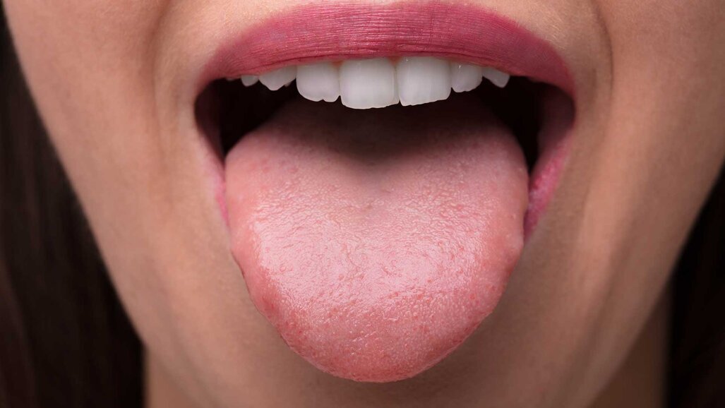 Glosodinija: Uzroci pečenja jezika