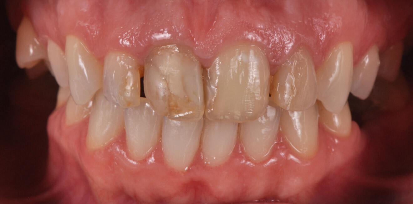 Fig. 1b: Female patient with discoloured anterior restorations desiring a smile makeover. Retracted view.
