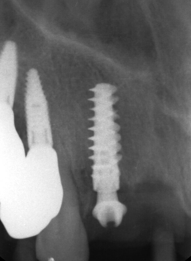 Fig. 67 - Rx SRA 1.2.