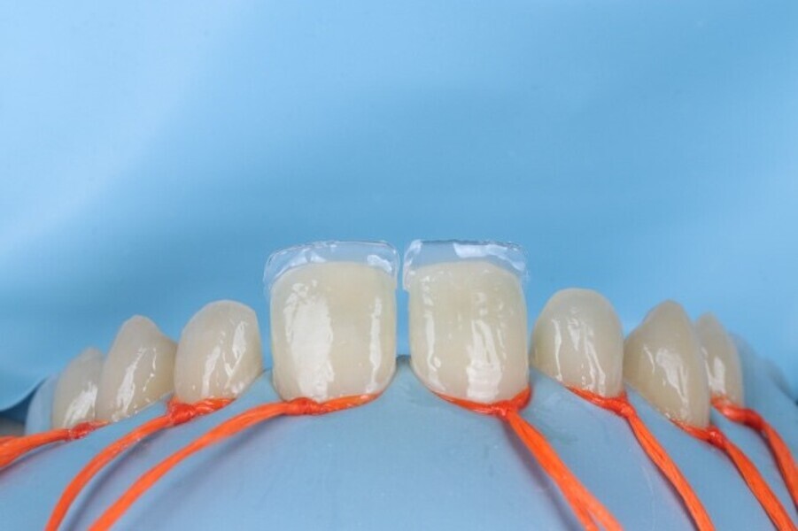 Fig. 3e: Multiple palatal shell  created for free hand build-up.