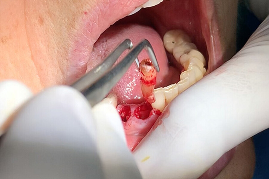 Figs. 7. Remoción delicada de los restos radiculares y comproba