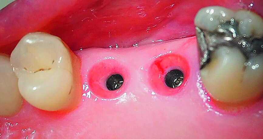 Fig. 21: The gingival tissue after removal of the sulcus formers.