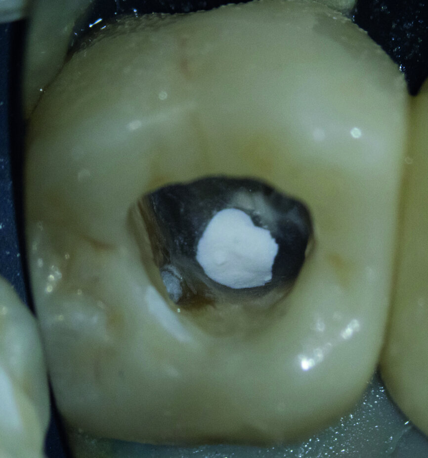 Fig. 7 : L’excès de ciment a été éliminé autant que possible. 