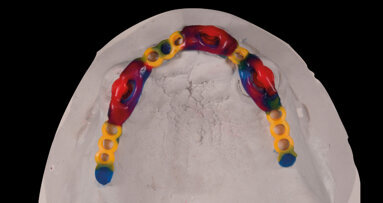 Il nuovo volto della protesi totale