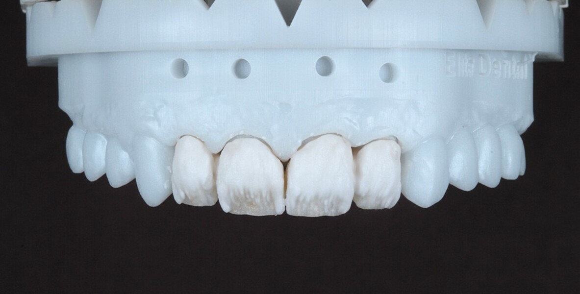 Fig. 8: Restorations on the model after layering in the cervical and body areas. 