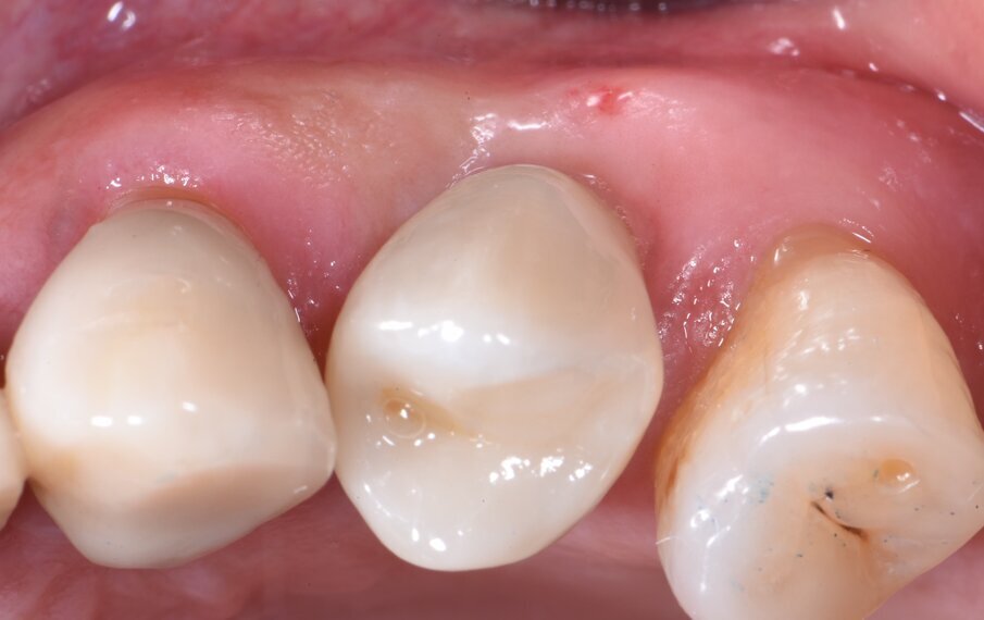 Fig. 5 - I volumi dei tessuti perimplantari sono sovrapponibili a quelli registrati prima dell’estrazione dentale.