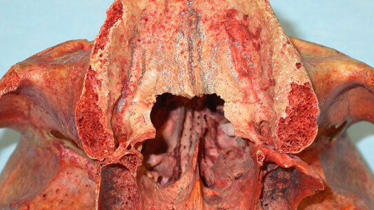 La regione palato-pterigo-tuberositaria: interesse chirurgico in implantologia