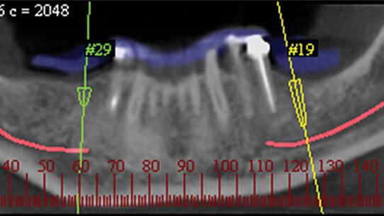 Virtual dental implant planning: the next step