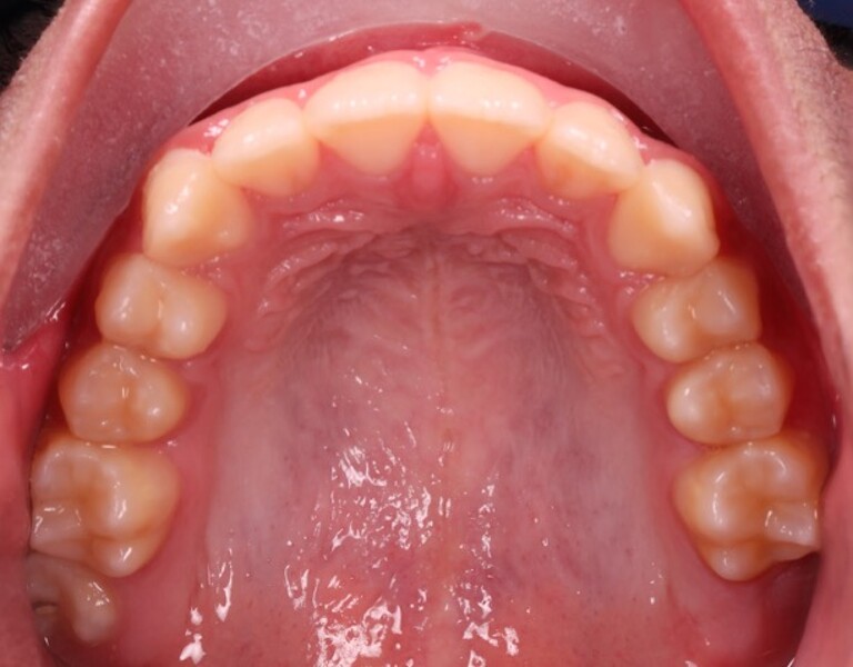 Figs. 8a–e: Intra-oral photographs after the second phase of treatment.
