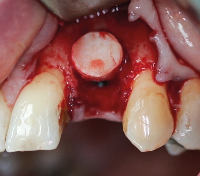 Fig. 28 : Carotte ostéo-gingivale impactée vue vestibulaire. 