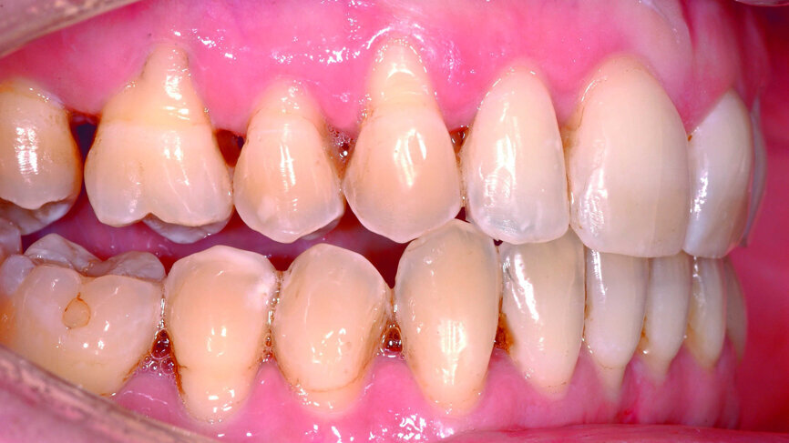 Fig. 3b : Vue de face post aligneur