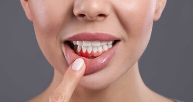 Gingivitis: Wie Mundgesundheit den Körper beeinflusst